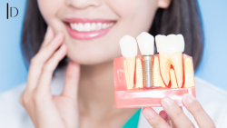 Perfecting Your Smile: Choosing the Best Dental Implants