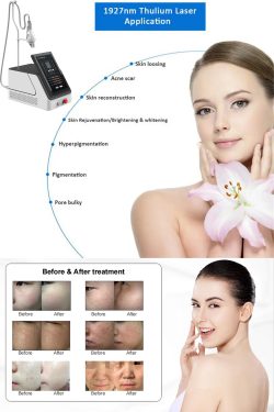 What is thulium laser used for?