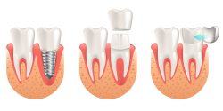Tooth Colored Crown & Bridges