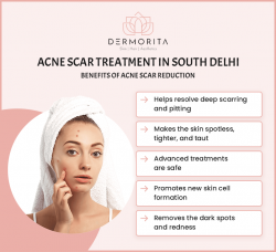Acne Scar Treatment in South Delhi