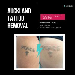 Effective Auckland Tattoo Removal at Laser Studio