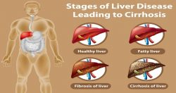 Best Liver Cirrhosis Treatment in India – MedTravellers