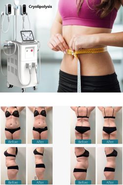 Things you to know about cryolipolysis