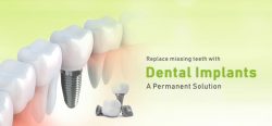 Painless Dental Implants in India