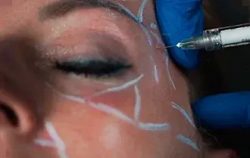 Dermal Fillers: Embrace Youthful Radiance in Leeds with Yorkshire Skin Centre