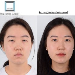 Double Eyelid Surgery in Korea at Mine Clinic