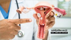 एंडोमेट्रियोसिस क्या है? Endometriosis Meaning in Hindi