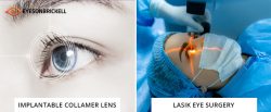 ICL vs. LASIK Eye Surgery: A Comprehensive Comparison Guide