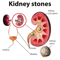 Kidney Stones Can Cause Terrible Pain. Dr. Niren Rao, A Kidney Stone Specialists in Delhi