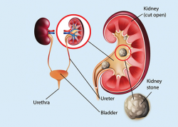 Kidney Stone Treatment in Bhosari: Understanding Options and Care
