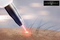 Men’s Laser Hair Removal Greenacre – Get Smooth Skin Today