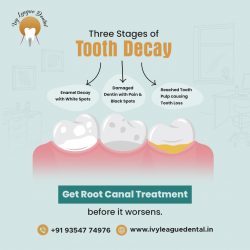 Early Treatment with Root Canal Therapy at Ivy League Dental Clinic