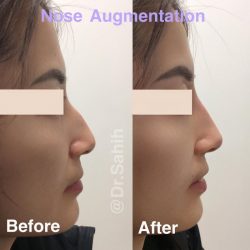 Choose Top Non-Surgical Nose Augmentation in Richmond by Richmond Cosmetic & Laser