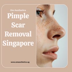 Flawless Skin: Your Guide to Pimple Scar Removal in Singapore
