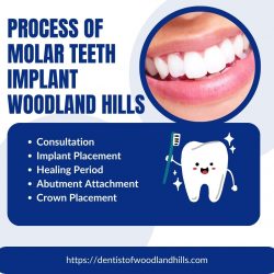 Long-term Benefits of Molar Teeth Implant