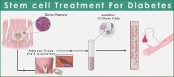 Stem Cell Therapy in India for Diabetes- MedTravellers