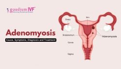 Adenomyosis: Cause, Symptoms, Diagnosis and Treatment