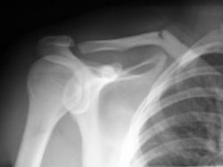 Everything You Need to Know About Clavicle Fractures