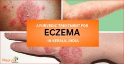 Ayurvedic Treatment for Eczema