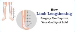 How Limb Lengthening Surgery Can Improve Your Quality of Life