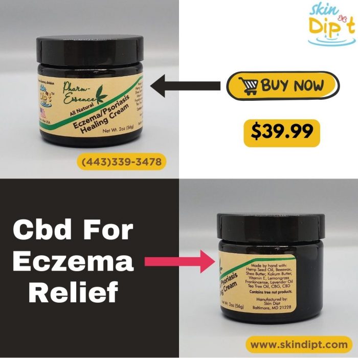 CBD for Eczema Relief – Natural Skincare