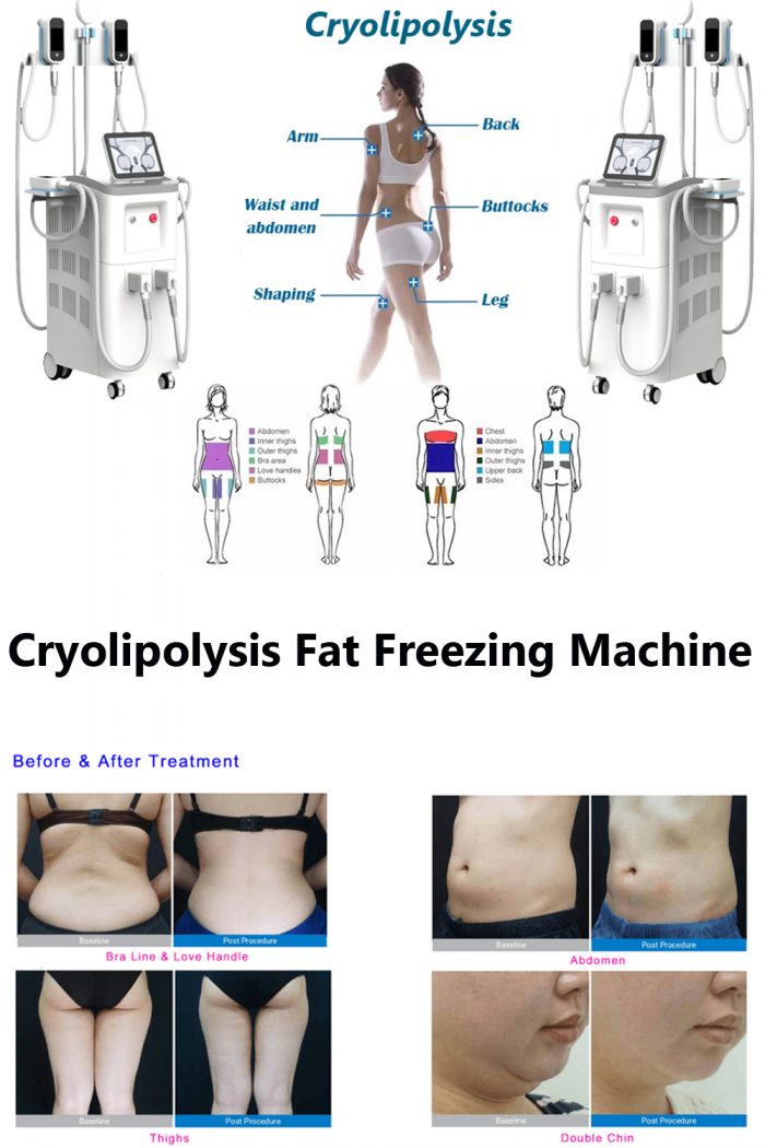 Do you lose weight when you do cryolipolysis treatment?