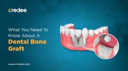 Dental Bone Graft: Cost, Benefits, Risks, And Candidacy
