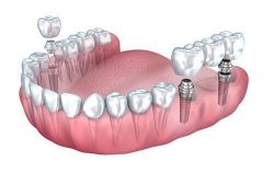 Are looking forth best Dental Implant Cost In Gurgaon