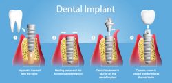 Remarkable Dental Implants in India