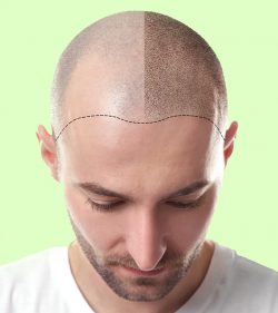 Discover the Best Hair Transplant Cost in Rajasthan