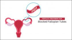 Fertility Treatment for Blocked Fallopian Tubes
