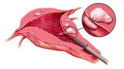 Understanding Fibroid Removal and Laparoscopic Ovarian Cystectomy