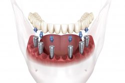 Full Arch Dental Implants Near Me In Houston