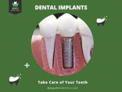 Advanced Dental Implants in Saibaba Colony, Coimbatore