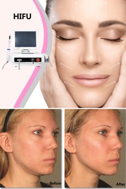 Non-surgical facial and skin rejuvenation with HIFU
