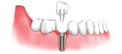 Implants in Casula: Revolutionizing Dental Care