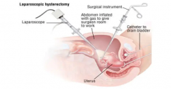 Understanding the Laparoscopic Hysterectomy Procedure