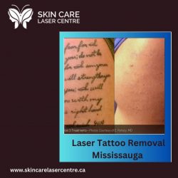 Laser Tattoo Removal Mississauga