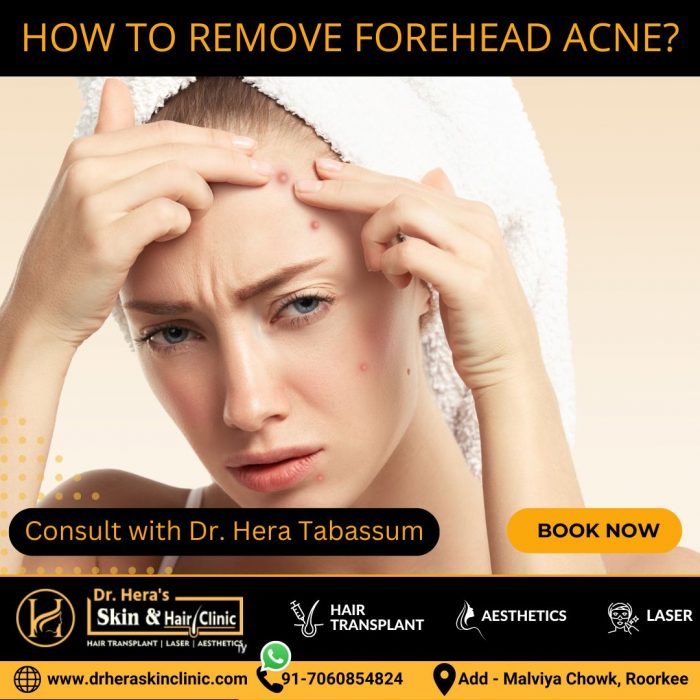 How To Remove Forehead Acne?