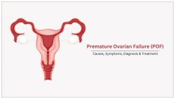 Premature ovarian failure (POF) Causes, Symptoms, Diagnosis & Treatment