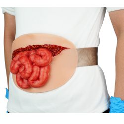Ultrassist Wearable Abdominal Wound Small Bowel Evisceration