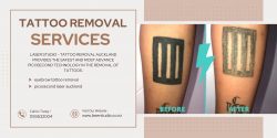 Erase the Past with Laser Studio’s Tattoo Removal Services in Auckland