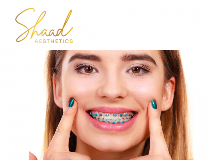 Orthodontic Treatment in Coimbatore – Straight Teeth with Orthodontics