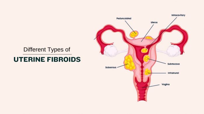 Understanding Different Types of Uterine Fibroids