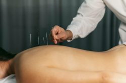 Acupuncture Therapy Florida