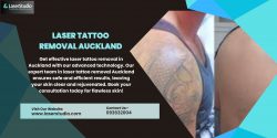 Affordable Laser Tattoo Removal Auckland Services