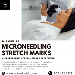 Understanding Microneedling: A Comprehensive Guide to Treating Stretch Marks
