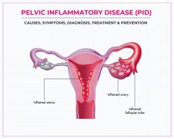Pelvic Inflammatory Disease (PID): Causes, Symptoms, Diagnosis, Treatment & Prevention