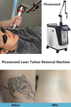 Frequently Asked and Questions about Picosecond Laser