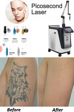 What Is the Best Tattoo Removal Laser?